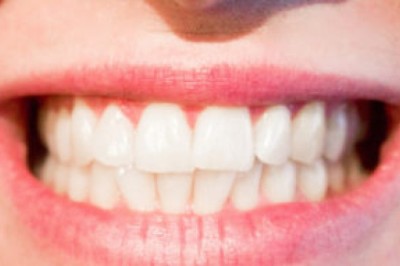 Dental Sealants In Abu Dhabi | Emirates Royal Center